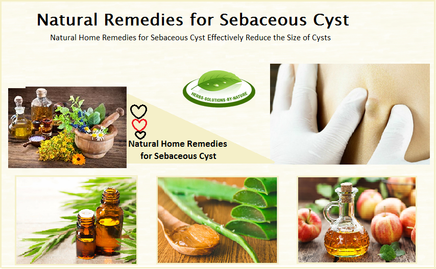 Natural-Treatment-for-Sebaceous-Cyst
