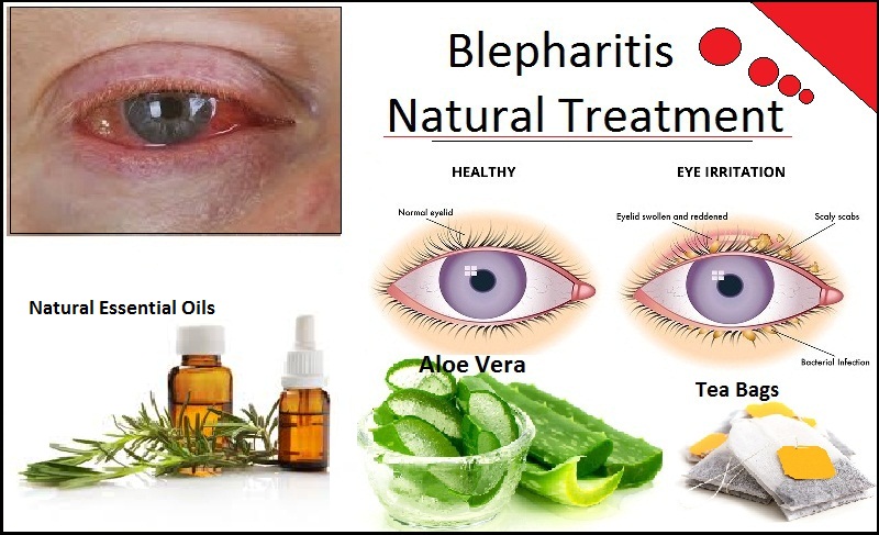 How To Get Rid Of Blepharitis With Natural Remedies Herbs Solutions By Nature 