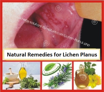 Herbal-Treatment-for-Lichen-Planus
