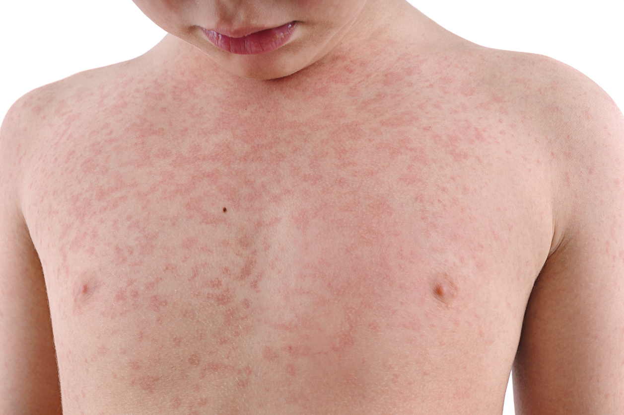 rashes-all-over-the-skin-red-alert-identifying-and-treating