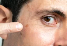 FDA Approves Tirbanibulin for Actinic Keratosis on Expanded Area of Face or Scalp