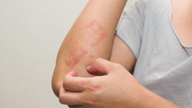 Lichen Planus Rash