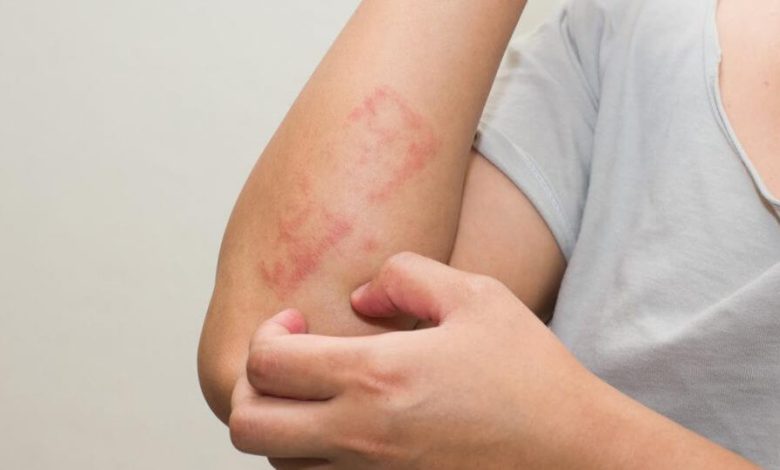 Lichen Planus Rash