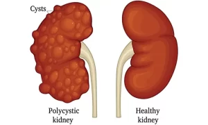 Reverse Polycystic Kidney Disease